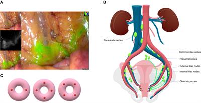 Sentinel Lymph Node Mapping in Endometrial Cancer: A Comprehensive Review